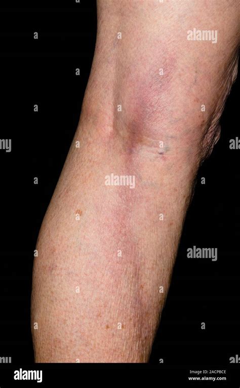 Superficial thrombophlebitis in the leg in an 85 year old female ...