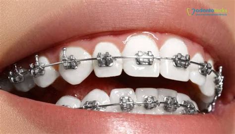 ¿Cómo cepillarse los dientes con brackets? | Odontotecks