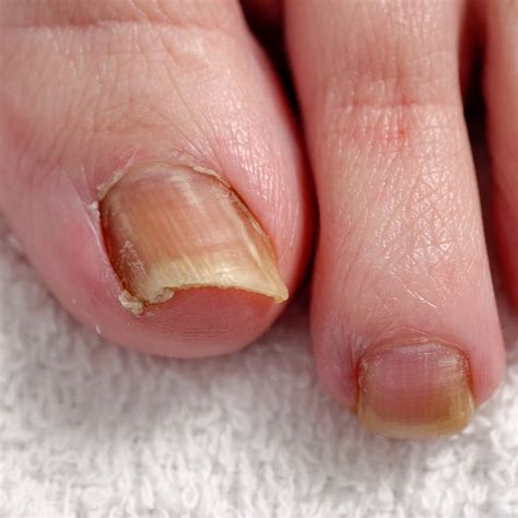 Involuted Toenail Trimming - Erica's ATA