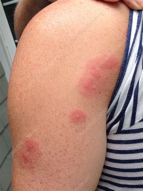 Insect Bites