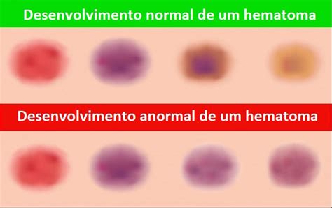 Hematoma Quanto Tempo Dura - Hematomas: Sintomas, causas e tratamentos | Saúde - TudoPorEmail