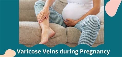 Varicose Veins during Pregnancy: All you need to know | FabMoms