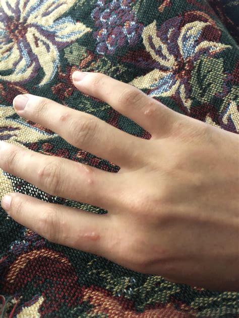 How to prevent poison ivy rash from spreading overnight. : r/howto