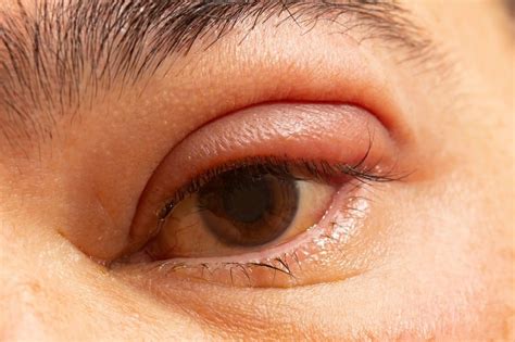 12 Best Home Remedies For Eye Infection (List) - OptingHealth