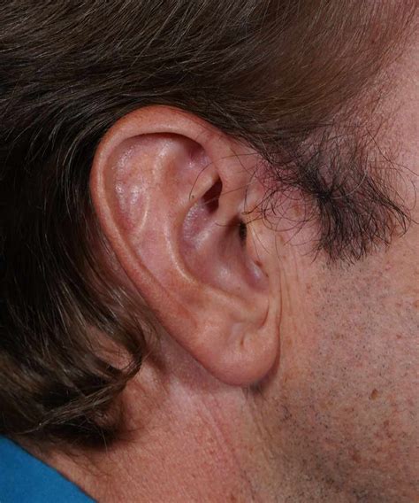 Is There Surgery to Reduce the Size of the Ear? | World Expert in ...