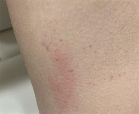 Red bumps on the back of my thighs : r/shaving