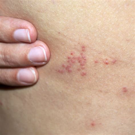 How Long Do Bed Bug Bites Last? | PestAdvisors.com