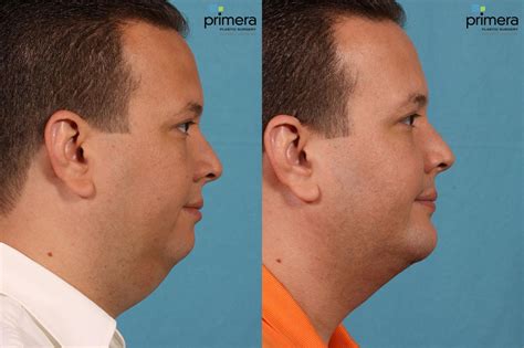 neck face liposuction    pictures case  orlando