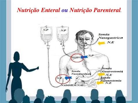 Nutrição Parenteral E Enteral