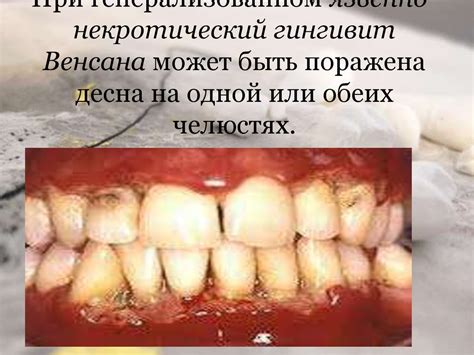 Язвенно-некротический гингивит Венсана - презентация онлайн