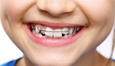 malocclusion misaligned bite types treatment
