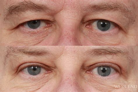 Upper Blepharoplasty Before And After Photos Fresh Fa - vrogue.co