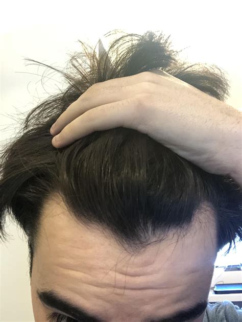 Do Widows Peaks Grow Back