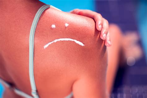 Why So Many Canadians Still Get Sunburned - Melanoma Canada