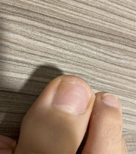 Is this discolouration nail fungus or something else? : r/NailFungus