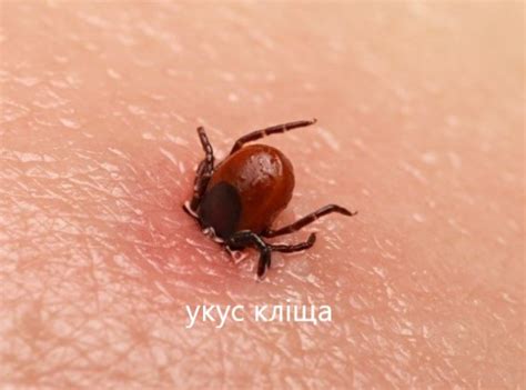 🔆УКУСИ літніх КОМАХ. ЯК ВИГЛЯДАЮТЬ? Симптоми. ДОГЛЯД ЗА УКУСОМ. ЯК ...