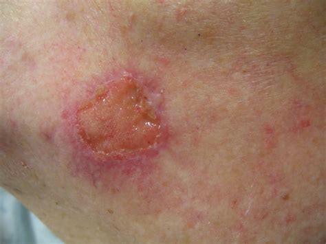 Squamous Cell Carcinoma Skin Cancer Symptoms