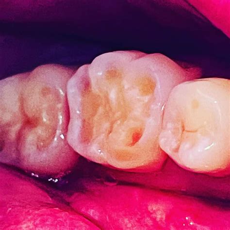 What is tooth erosion? – Dr. Ljubica Banić