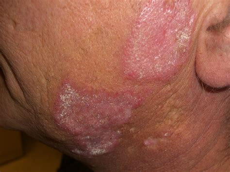 What Does A Erfly Rash Look Like - Infoupdate.org