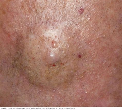 Early Cutaneous T Cell Lymphoma Stages