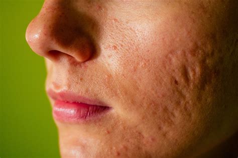 Acne Scars Face
