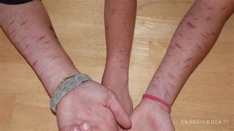 retoma importancia casos de cutting en jovenes estudiantes se autolesionan