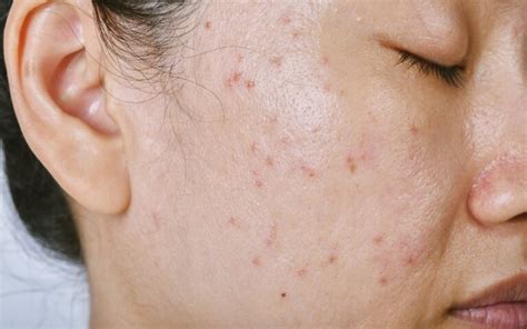 Understanding Acne Papules: Causes, Treatment, and Prevention ...