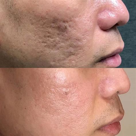 laser  scars treatment