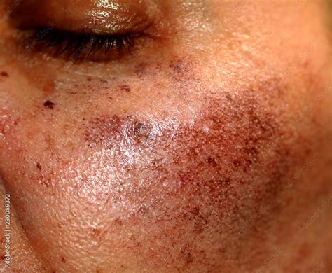 pigmented spots   face pigmentation  cheeks stock photo adobe