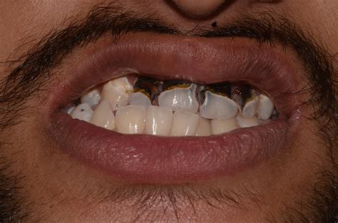 Dentosphere : World of Dentistry: Fluoridated vs. Non-Fluoridated ...