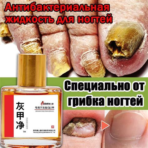 Масло для ногтей от грибка 25мл,руках, для лечения грибка и онихолизиса ...