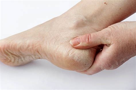 Foot Problems