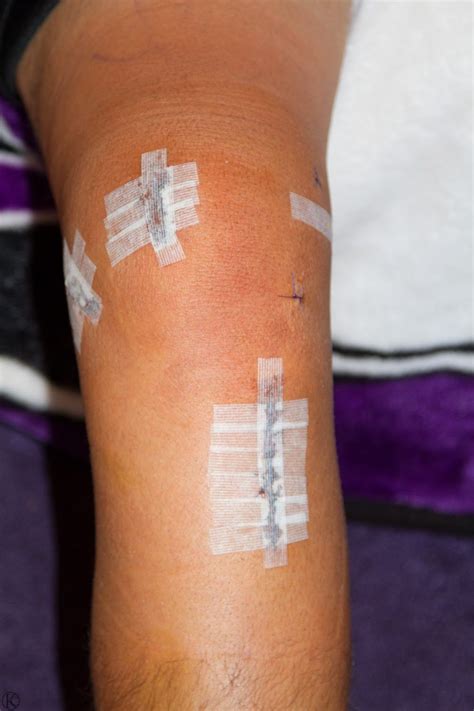 scar from total knee replacement - goossendonte