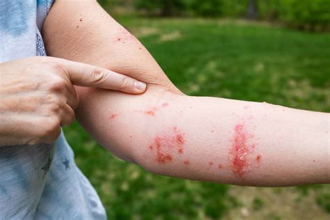 Poison Ivy Treatment | Soothe and Heal Your Skin | DermDox