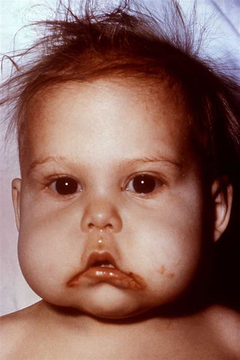 Kwashiorkor - Wikiwand