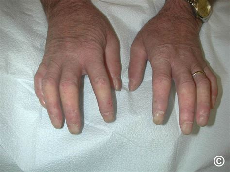 Systemic sclerosis