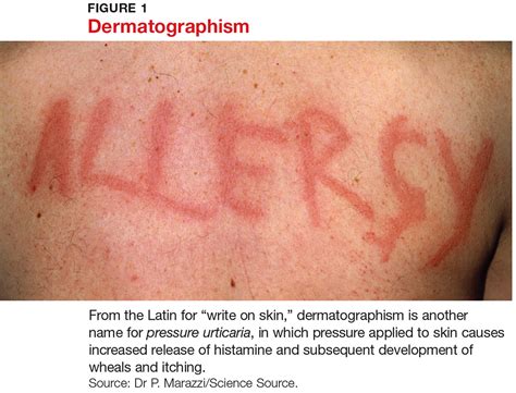 Urticaria Pigmentosa Pictures Symptoms Causes Treatment