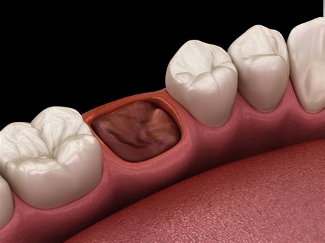 Preventing Dry Socket After Extraction: Expert Tips
