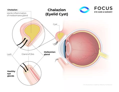 Chalazion Treatment Queens NYC Long Island NY