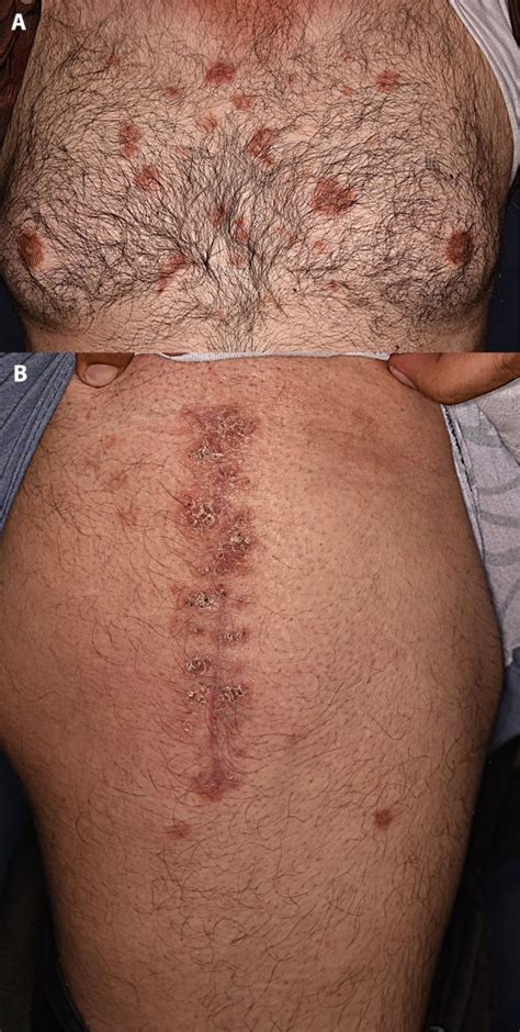 koebner phenomenon   rituximab treated pemphigus patient beware
