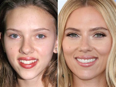 Celebrity Teeth Before And After
