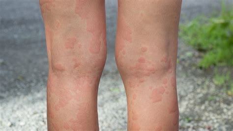 Nesselsucht (Urtikaria): Ursachen, Symptome, Behandlung