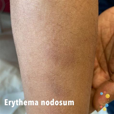 Erythema nodosum - Skin Deep