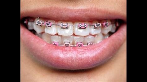 Fake braces are the latest trend in Asia | fox43.com