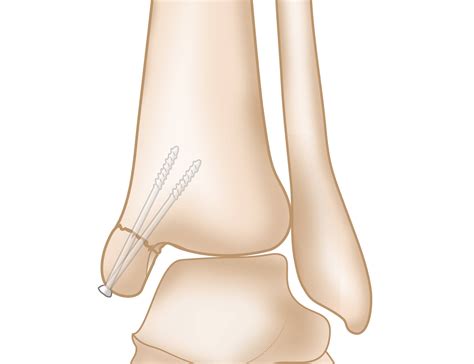 Medial Malleolus Anatomy