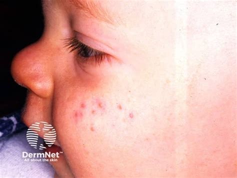 DermNet® - Infantile acne image