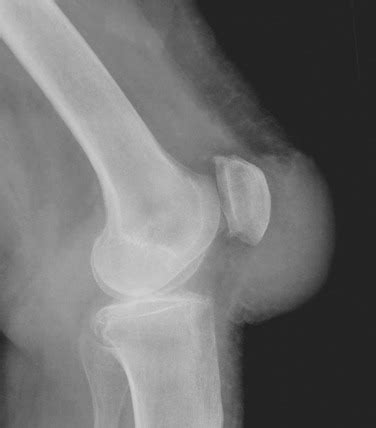 Prepatellar Bursitis | Anesthesia Key