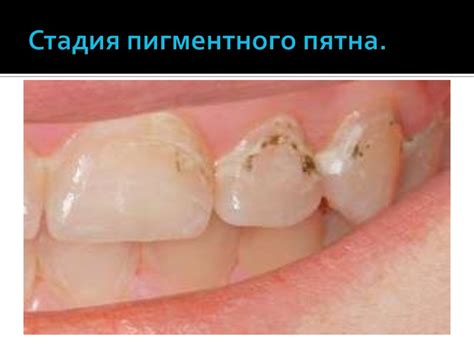 Стадии кариеса: меловое пятно, пигментированное, поверхностный кариес ...