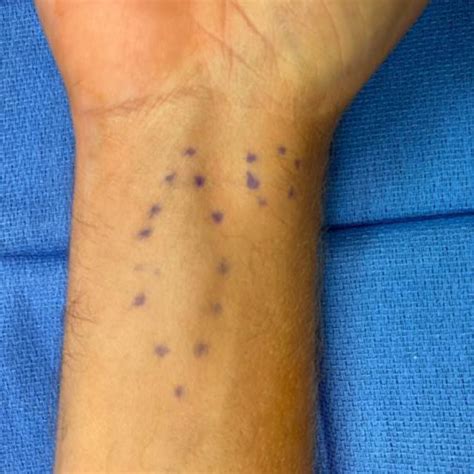 Preoperative preparation demonstrating 2 adjacent volar wrist masses ...