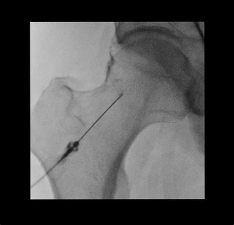 Hip injection (disambiguation) | Radiology Reference Article ...